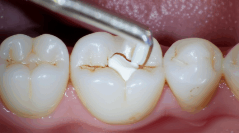 How Dentists Fix Cracked Teeth Your Comprehensive Guide to Repair Options