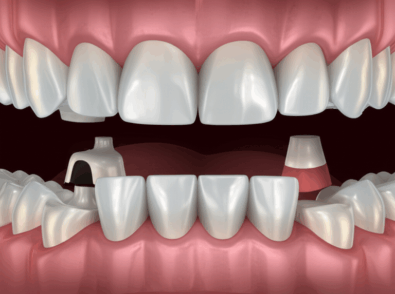 How Does a Dentist Do a Bridge