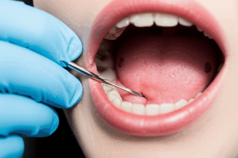 How a Dentist Effectively Treats Dry Socket What to Expect for Pain Relief and Healing
