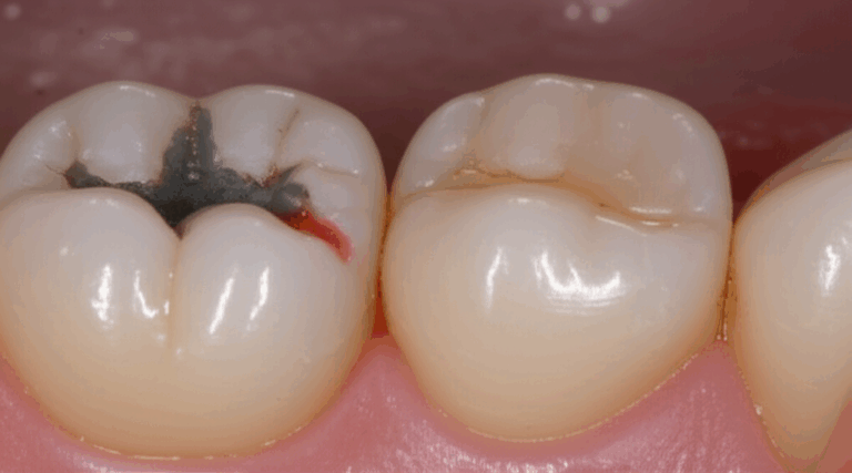 Is Your Dentist Responsible for a Failed Filling Understanding Your Rights Next Steps